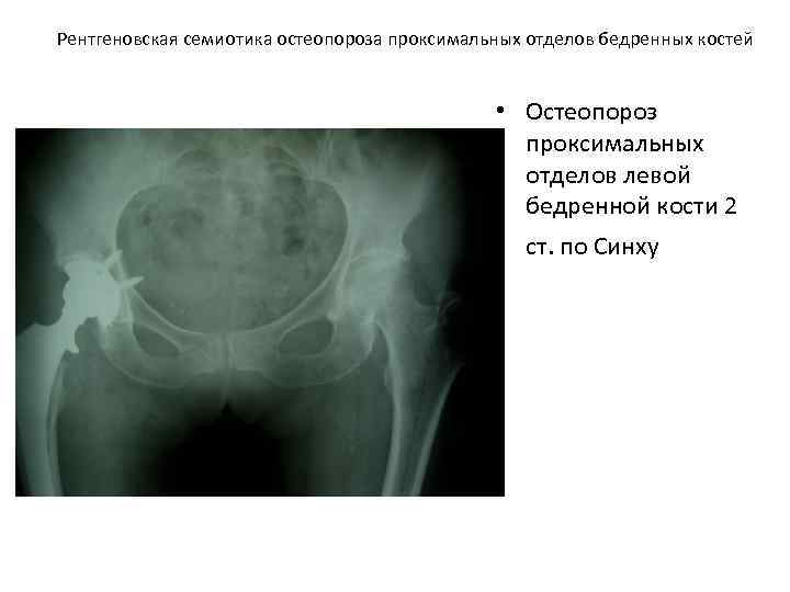 Рентгеновская семиотика остеопороза проксимальных отделов бедренных костей • Остеопороз проксимальных отделов левой бедренной кости
