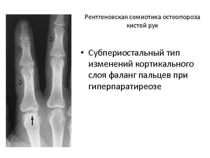Кортикальная кость. Утолщение кортикального слоя кости. Утолщение кортикального слоя фаланги. Корковый слой кости на рентгене. Кортикальный слой кости на рентгене.