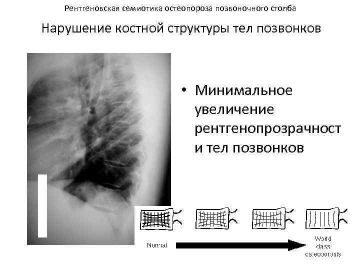 Рентгеновская семиотика остеопороза позвоночного столба Нарушение костной структуры тел позвонков • Минимальное увеличение рентгенопрозрачност