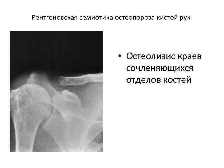 Остеолиз это. Остеолизис костей на рентгене. Остеолизис бедренной кости. Остеолиз кости рентген.
