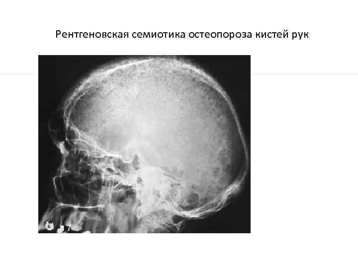 Рентгеновская семиотика остеопороза кистей рук 