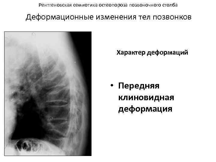 Рентгеновская семиотика остеопороза позвоночного столба Деформационные изменения тел позвонков Характер деформаций • Передняя клиновидная
