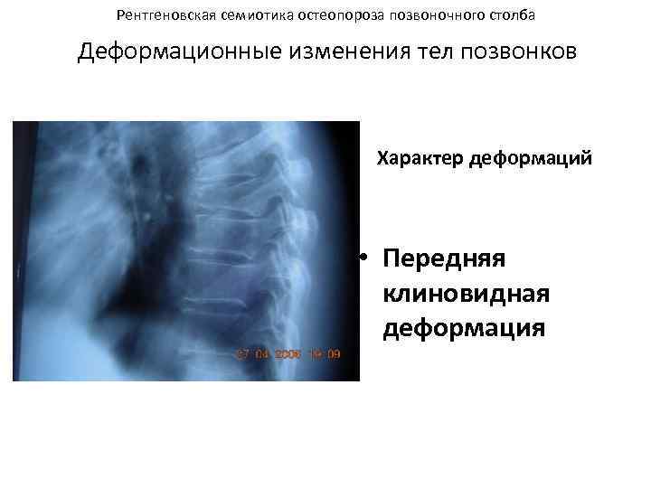 Рентгеновская семиотика остеопороза позвоночного столба Деформационные изменения тел позвонков Характер деформаций • Передняя клиновидная