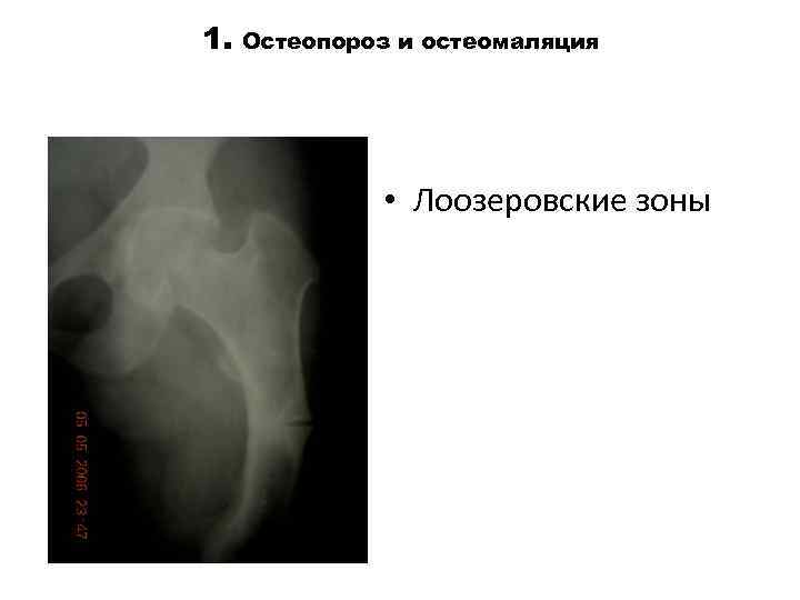 1. Остеопороз и остеомаляция • Лоозеровские зоны 