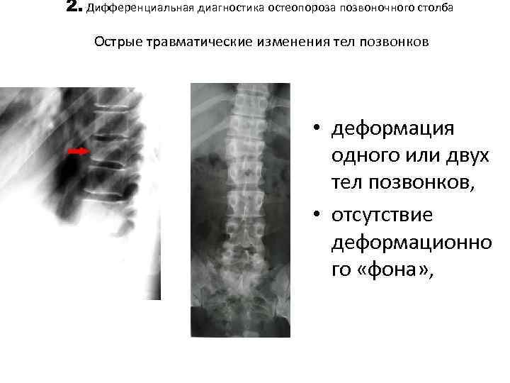 2. Дифференциальная диагностика остеопороза позвоночного столба Острые травматические изменения тел позвонков • деформация одного