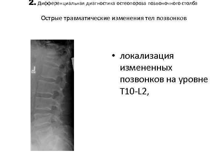 2. Дифференциальная диагностика остеопороза позвоночного столба Острые травматические изменения тел позвонков • локализация измененных