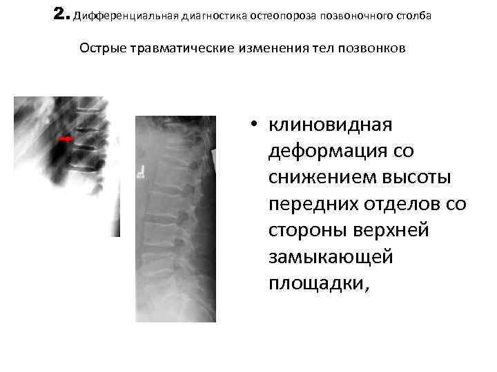 Позвоночник деформирован. Боковая клиновидная деформация тела позвонка. Передняя клиновидная деформация тел позвонков. Остеопороз дифференциальная диагностика. Клиновидная деформация тела позвонка диагноз.