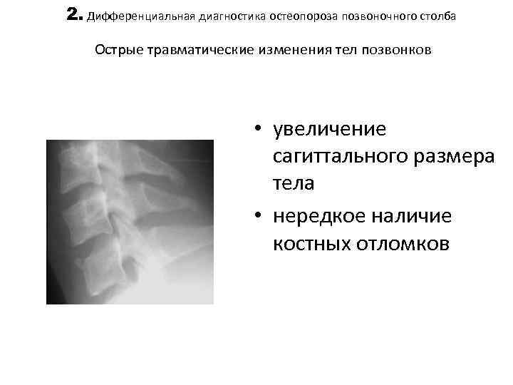 2. Дифференциальная диагностика остеопороза позвоночного столба Острые травматические изменения тел позвонков • увеличение сагиттального