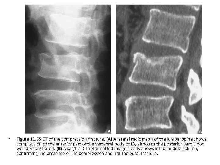 • Figure 11. 55 CT of the compression fracture. (A) A lateral radiograph
