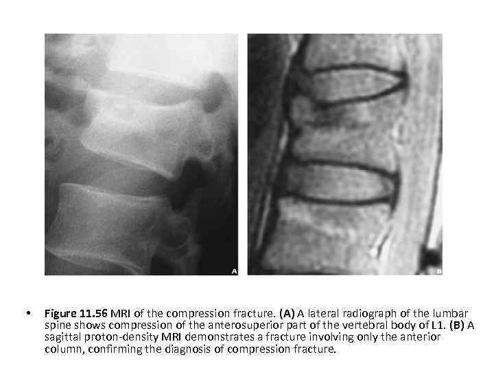  • Figure 11. 56 MRI of the compression fracture. (A) A lateral radiograph