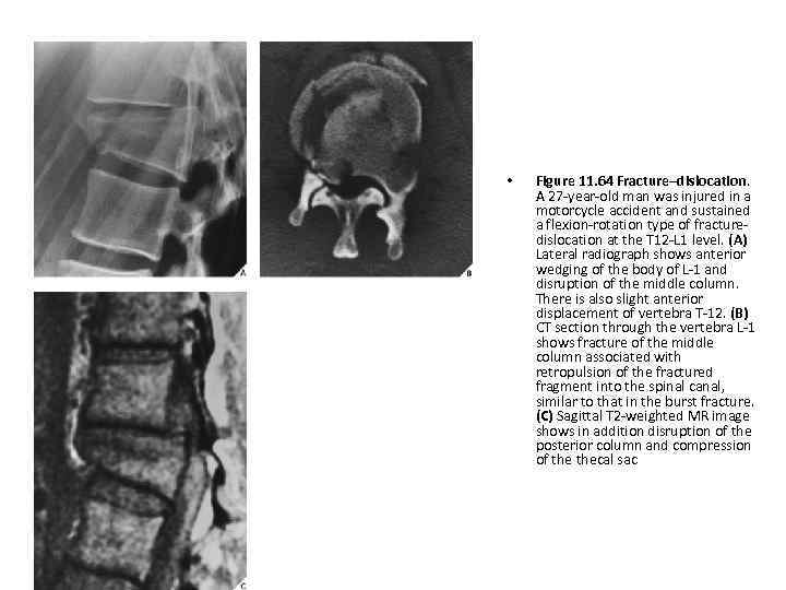  • Figure 11. 64 Fracture–dislocation. A 27 -year-old man was injured in a