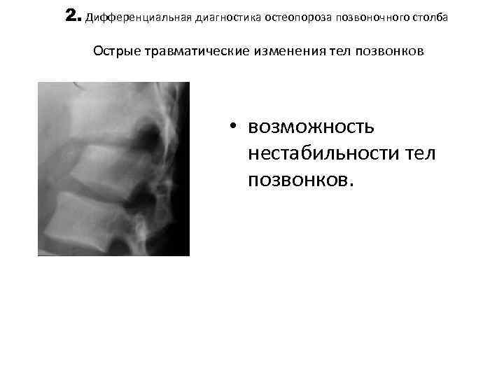 2. Дифференциальная диагностика остеопороза позвоночного столба Острые травматические изменения тел позвонков • возможность нестабильности