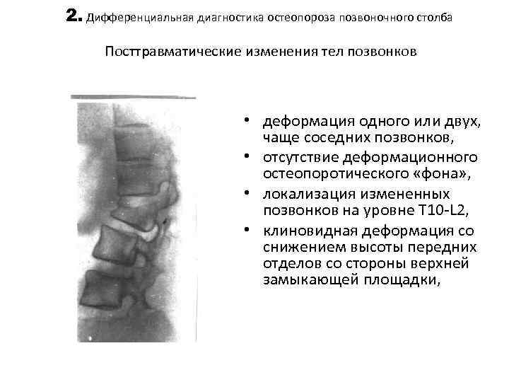 Деформация позвонков