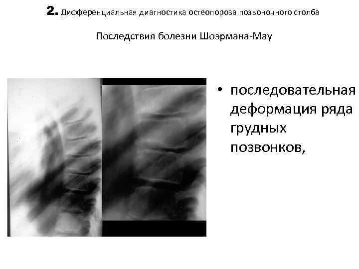 2. Дифференциальная диагностика остеопороза позвоночного столба Последствия болезни Шоэрмана-Мау • последовательная деформация ряда грудных