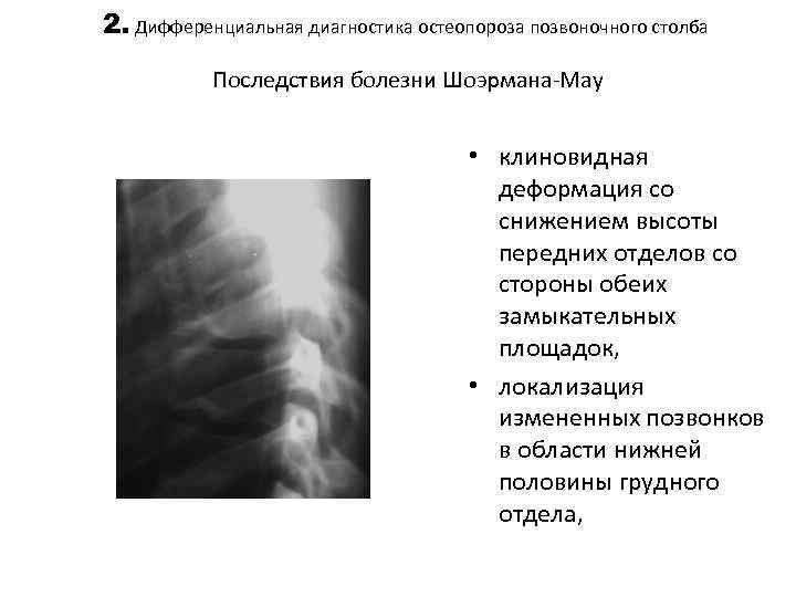 2. Дифференциальная диагностика остеопороза позвоночного столба Последствия болезни Шоэрмана-Мау • клиновидная деформация со снижением