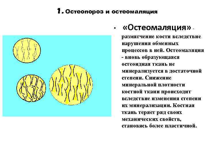 1. Остеопороз и остеомаляция • «Остеомаляция» размягчение кости вследствие нарушения обменных процессов в ней.