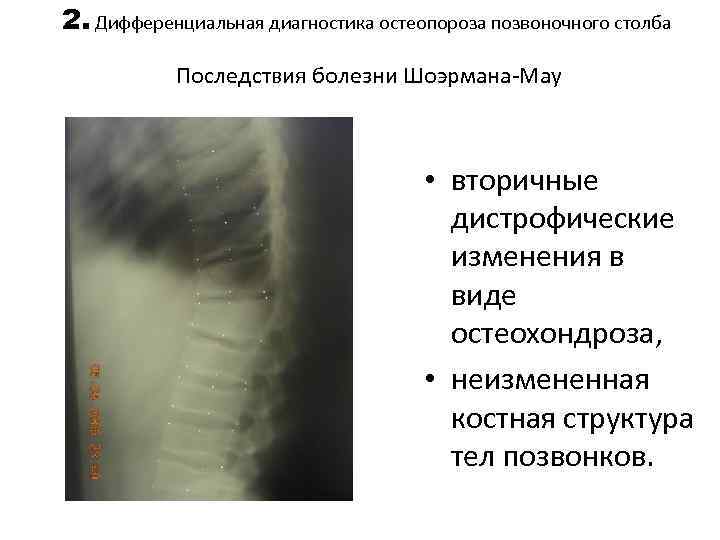 2. Дифференциальная диагностика остеопороза позвоночного столба Последствия болезни Шоэрмана-Мау • вторичные дистрофические изменения в