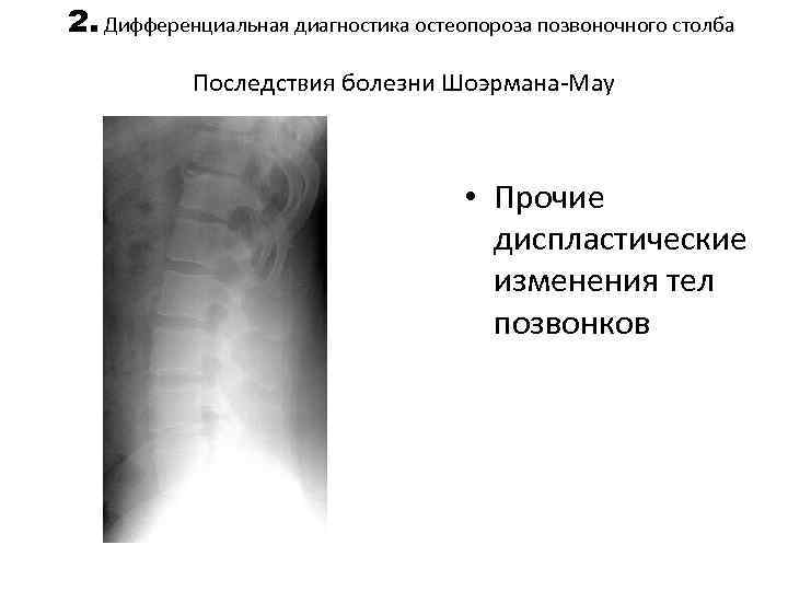 2. Дифференциальная диагностика остеопороза позвоночного столба Последствия болезни Шоэрмана-Мау • Прочие диспластические изменения тел
