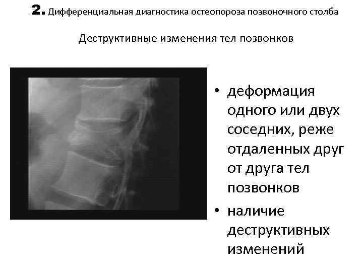 2. Дифференциальная диагностика остеопороза позвоночного столба Деструктивные изменения тел позвонков • деформация одного или