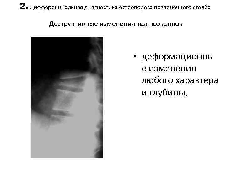 2. Дифференциальная диагностика остеопороза позвоночного столба Деструктивные изменения тел позвонков • деформационны е изменения
