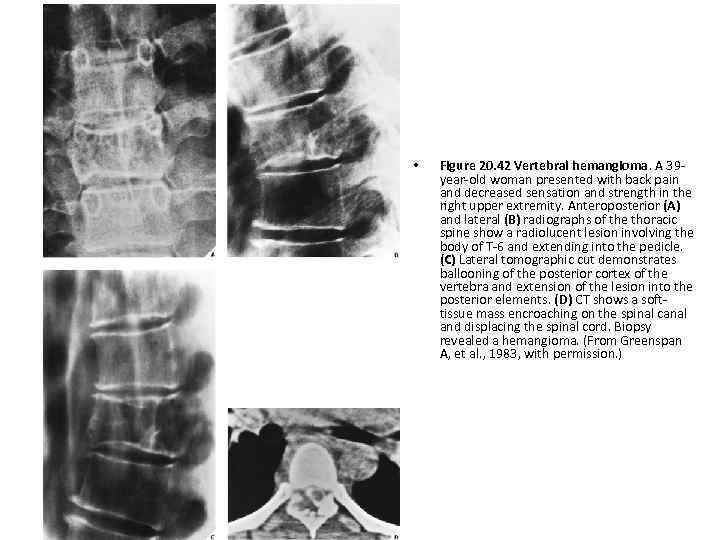  • Figure 20. 42 Vertebral hemangioma. A 39 year-old woman presented with back