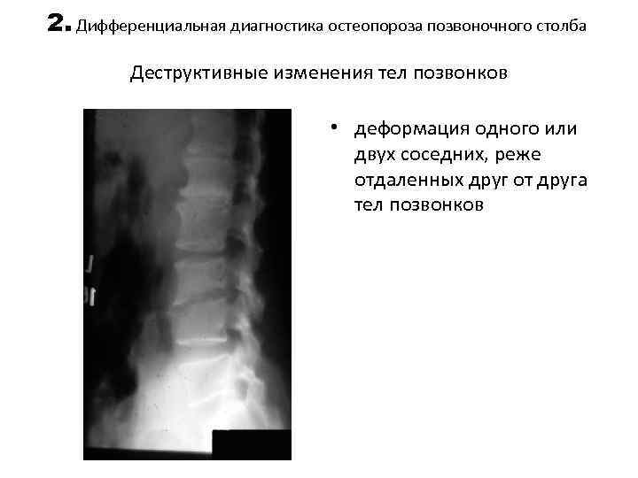 2. Дифференциальная диагностика остеопороза позвоночного столба Деструктивные изменения тел позвонков • деформация одного или