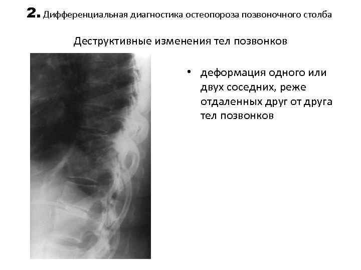2. Дифференциальная диагностика остеопороза позвоночного столба Деструктивные изменения тел позвонков • деформация одного или