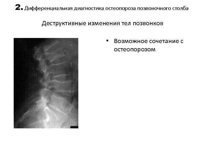2. Дифференциальная диагностика остеопороза позвоночного столба Деструктивные изменения тел позвонков • Возможное сочетание с