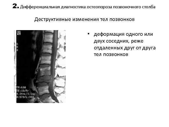 2. Дифференциальная диагностика остеопороза позвоночного столба Деструктивные изменения тел позвонков • деформация одного или