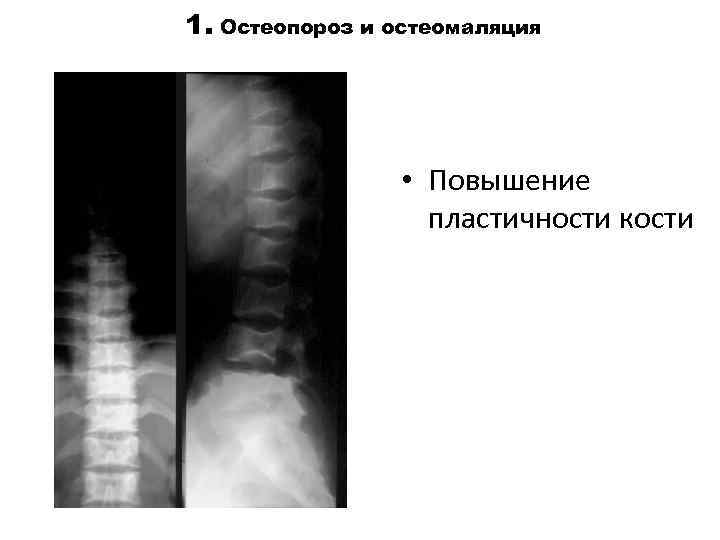 1. Остеопороз и остеомаляция • Повышение пластичности кости 