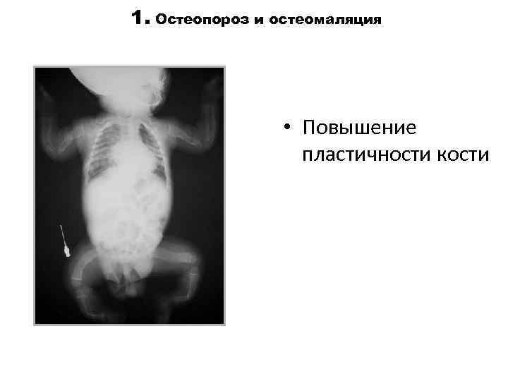 1. Остеопороз и остеомаляция • Повышение пластичности кости 