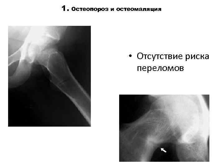 1. Остеопороз и остеомаляция • Отсутствие риска переломов 