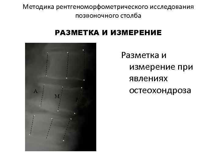 Методика рентгеноморфометрического исследования позвоночного столба РАЗМЕТКА И ИЗМЕРЕНИЕ М А М Р Р Разметка