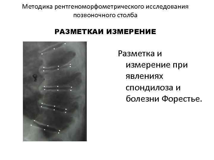 Методика рентгеноморфометрического исследования позвоночного столба РАЗМЕТКАИ ИЗМЕРЕНИЕ М Р Разметка и измерение при явлениях