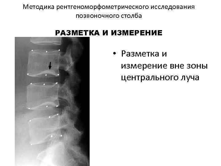 Методика рентгеноморфометрического исследования позвоночного столба РАЗМЕТКА И ИЗМЕРЕНИЕ • Разметка и измерение вне зоны