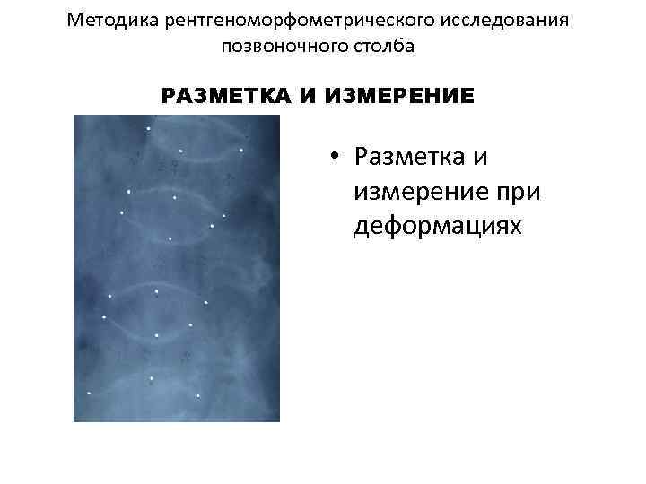 Методика рентгеноморфометрического исследования позвоночного столба РАЗМЕТКА И ИЗМЕРЕНИЕ • Разметка и измерение при деформациях