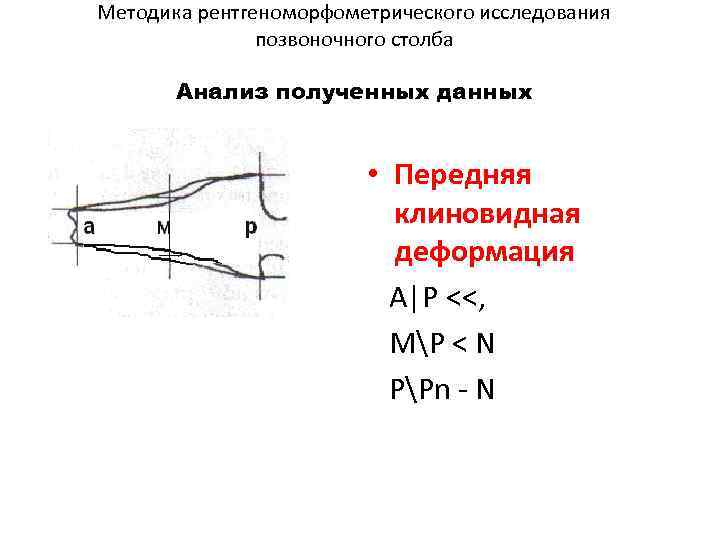 Методика рентгеноморфометрического исследования позвоночного столба Анализ полученных данных • Передняя клиновидная деформация A|P <<,