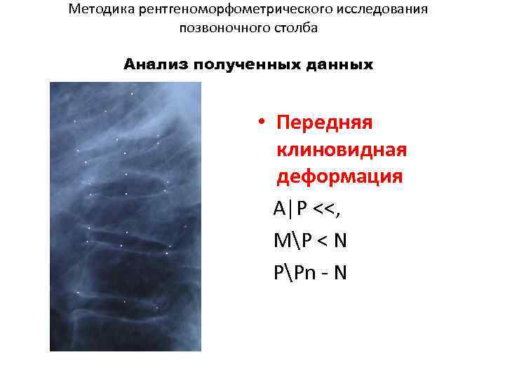 Методика рентгеноморфометрического исследования позвоночного столба Анализ полученных данных • Передняя клиновидная деформация A|P <<,