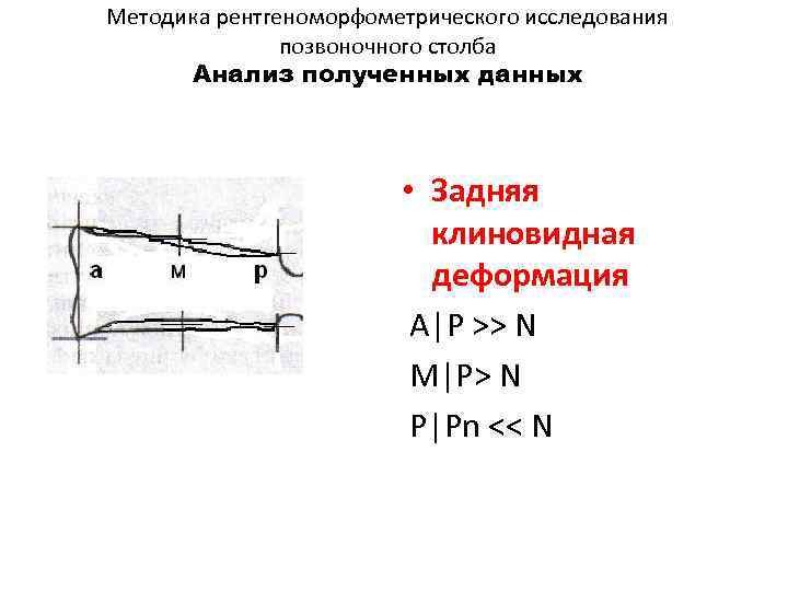 Методика рентгеноморфометрического исследования позвоночного столба Анализ полученных данных • Задняя клиновидная деформация A|P >>