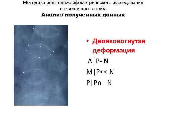 Методика рентгеноморфометрического исследования позвоночного столба Анализ полученных данных • Двояковогнутая деформация A|P- N M|P<<