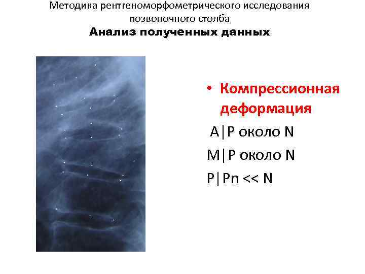 Методика рентгеноморфометрического исследования позвоночного столба Анализ полученных данных • Компрессионная деформация A|P около N