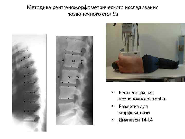 Методика рентгеноморфометрического исследования позвоночного столба . . . . а. . м . .