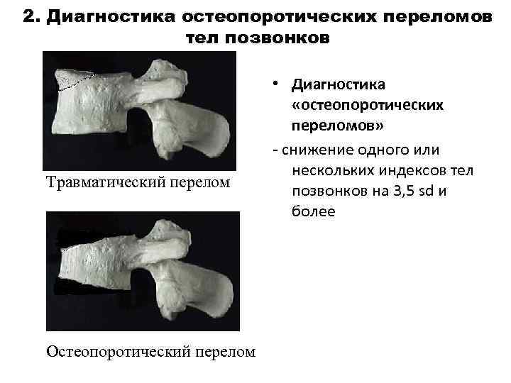 2. Диагностика остеопоротических переломов тел позвонков Травматический перелом Остеопоротический перелом • Диагностика «остеопоротических переломов»