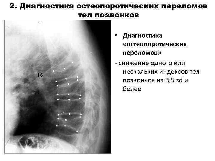 2. Диагностика остеопоротических переломов тел позвонков Т 6 Т 7 Т 9 • Диагностика