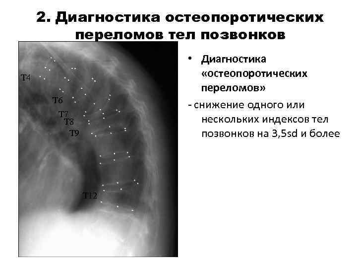 2. Диагностика остеопоротических переломов тел позвонков • Диагностика «остеопоротических переломов» - снижение одного или