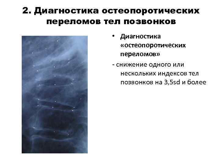 2. Диагностика остеопоротических переломов тел позвонков • Диагностика «остеопоротических переломов» - снижение одного или