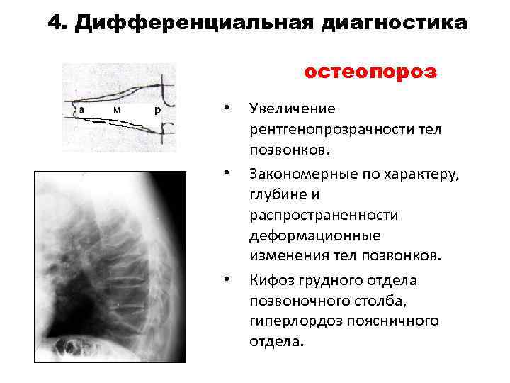 4. Дифференциальная диагностика остеопороз • • • Увеличение рентгенопрозрачности тел позвонков. Закономерные по характеру,