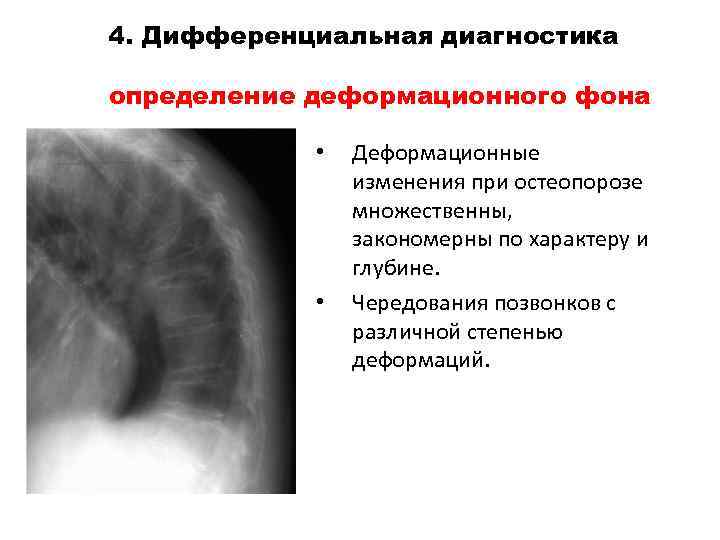 4. Дифференциальная диагностика определение деформационного фона • • Деформационные изменения при остеопорозе множественны, закономерны