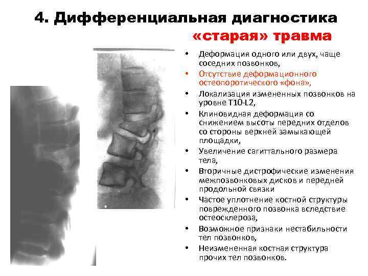 4. Дифференциальная диагностика «старая» травма • • • Деформация одного или двух, чаще соседних