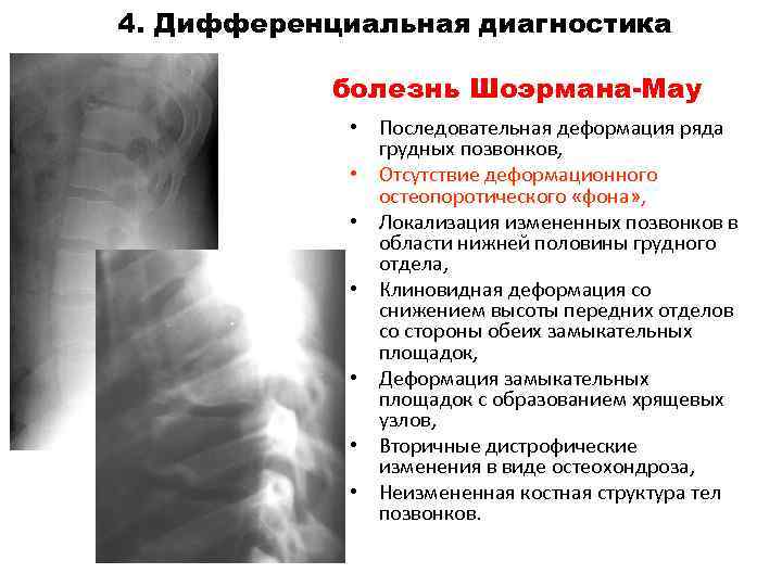 Болезнь шейермана по утвержденным клиническим рекомендациям. Остеохондропатия Шейерман-МАУ. Шойерман-МАУ болезнь рентгенологические.